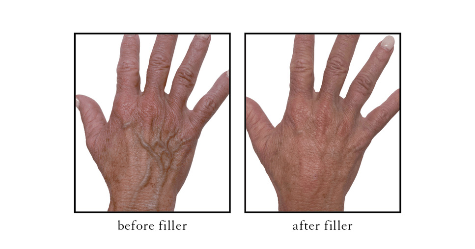 Before and After hand rejuvenation